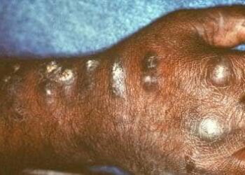 WHO recommends ‘mpox’ as new name for monkeypox