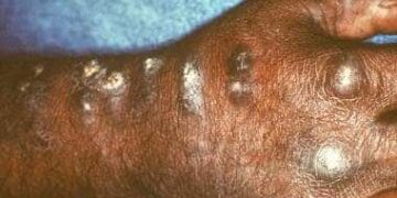WHO recommends ‘mpox’ as new name for monkeypox