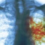 Price reduction paves way for access to multidrug-resistant TB treatment