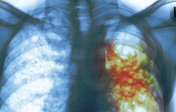 Price reduction paves way for access to multidrug-resistant TB treatment