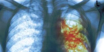 Price reduction paves way for access to multidrug-resistant TB treatment