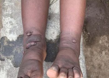 Rwandans urged to wear shoes to prevent foot diseases