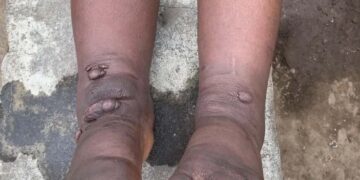 Rwandans urged to wear shoes to prevent foot diseases