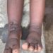 Rwandans urged to wear shoes to prevent foot diseases