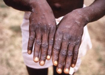 DRC faces new threat: Mpox outbreak with potential for wider spread