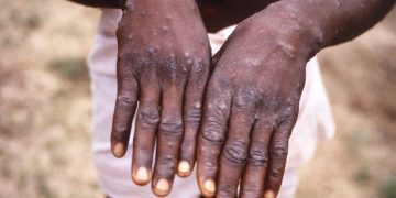 DRC faces new threat: Mpox outbreak with potential for wider spread