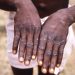 DRC faces new threat: Mpox outbreak with potential for wider spread