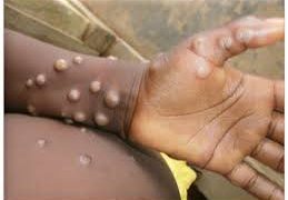 Global Concerns Rise as Mpox Outbreak Escalates in Africa