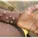 Global Concerns Rise as Mpox Outbreak Escalates in Africa