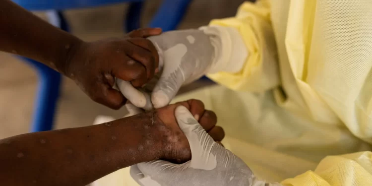 Africa Declares Public Health Emergency Over Worsening Mpox Outbreak