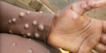 Surge in Mpox Cases Reported in Rwanda, Mostly Linked to Sexual Contact